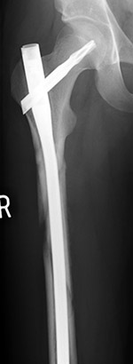 Antegrade IM hip nail